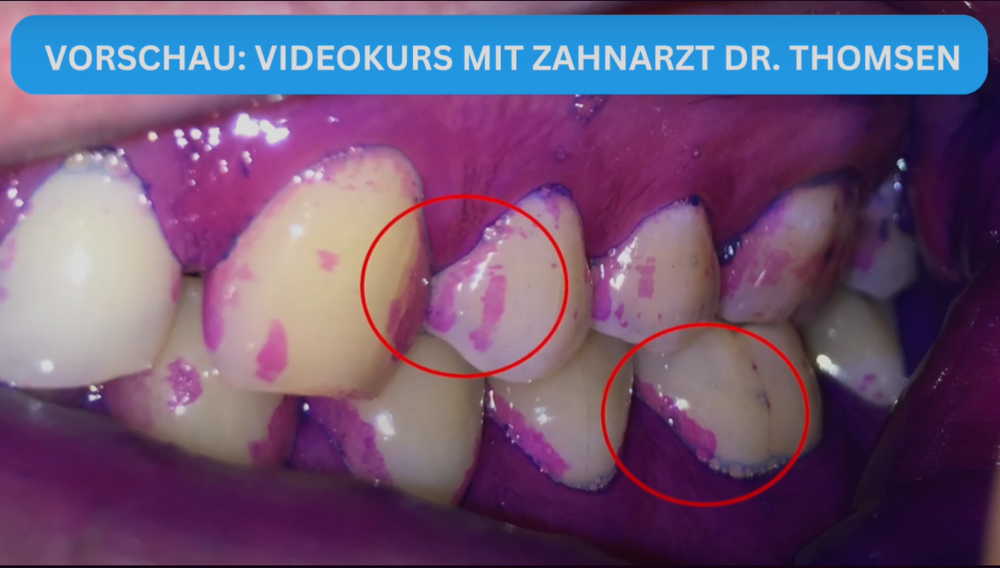 
            
                Laden und Abspielen von Videos im Galerie-Viewer, Oral Prevent Zahnpflege Starter Set + GRATIS Videokurs mit Zahnarzt Dr. Thomsen
            
        
